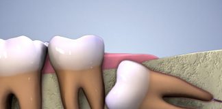 Изваждането на мъдреците / Най-голямата стоматологична измама и защо имате нужда от тях